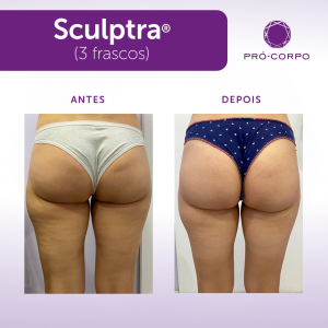 Sculptra Antes e Depois